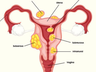 Umuthi Wenzalo STDs Fibroids Disease +27780201356