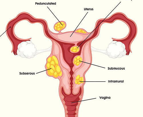 Umuthi Wenzalo STDs Fibroids Disease +27780201356