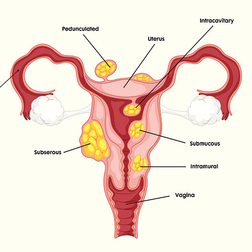 Umuthi Wenzalo STDs Fibroids Disease +27780201356