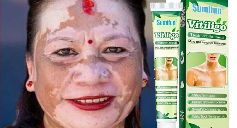 Get Rid Of Vitiligo In Pie Corner City In Barbados
