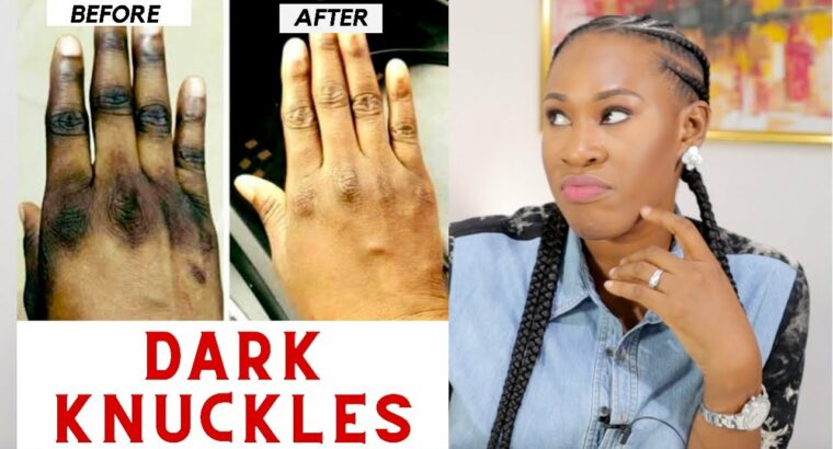 Dark Knuckle Whitening Serum Call +27710732372